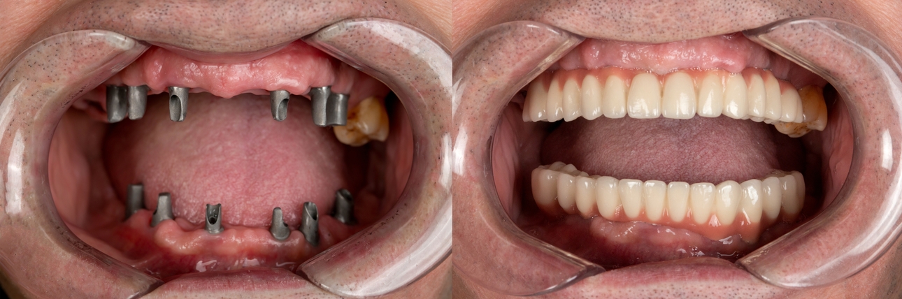 Implantes dentários